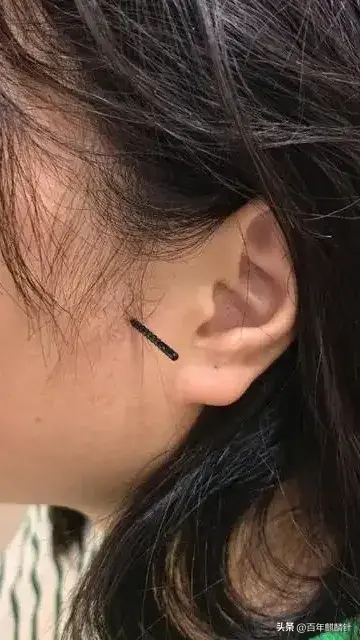 鼻炎患者狂喜！一根针扎这里，鼻塞30秒通！西医VS中医终极对比！