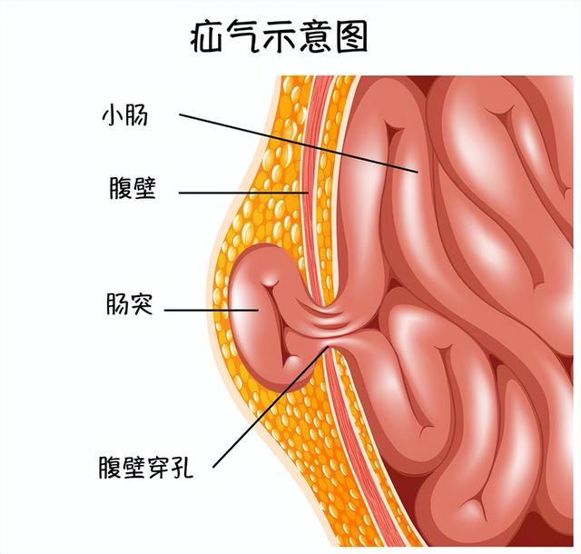 我们常说的“小肠气”是怎么回事？快来了解一下