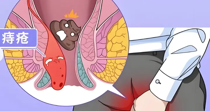 痔疮频繁复发怎么办？专家提醒：做好这5件事有助缓解