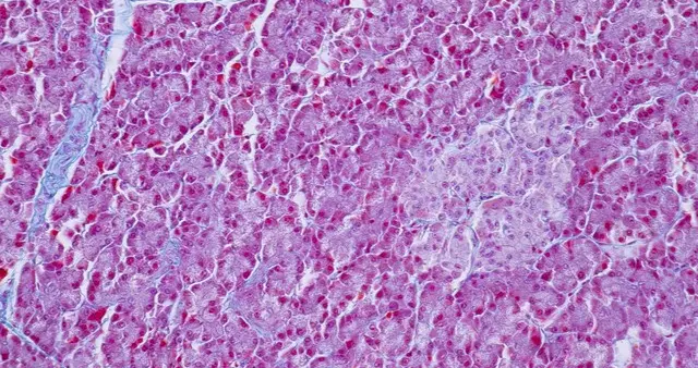 “主任，我肝弹8.1，是不是肝硬化了？”说清肝弹值与用药的情况