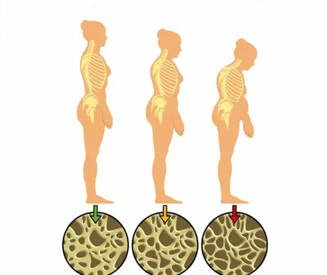 治疗骨质疏松症，除了激素药，还有别的吗，该怎么选？
