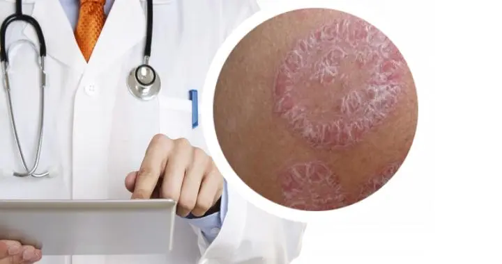 全球首款！银屑病治疗迎来“口服”创新药！七成患者皮损几乎清除