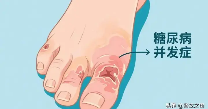 别让“糖足”偷走你的双脚——无声的警报：糖尿病足的早期信号