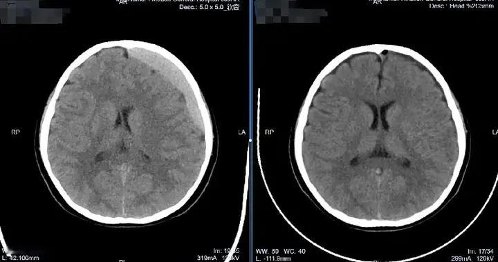 软性神经内镜精准微创，守护硬膜下血肿患儿稚嫩的“司令部”
