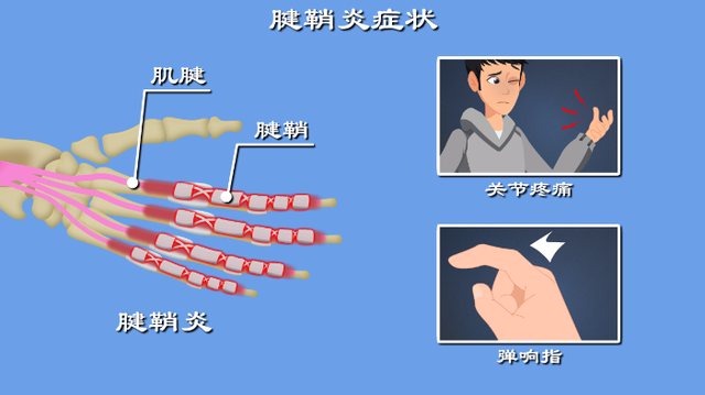 腱鞘炎是筋伤的痛，一个神通广大中成药可止