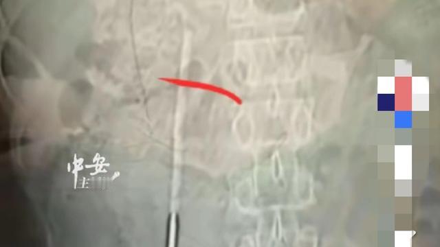 余小丢：惊出冷汗！12岁吞体温计瞒20年
