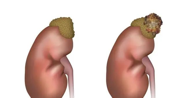 体检查出肾囊肿别慌！根源在2滞2虚，中医通补结合调，看懂少焦虑