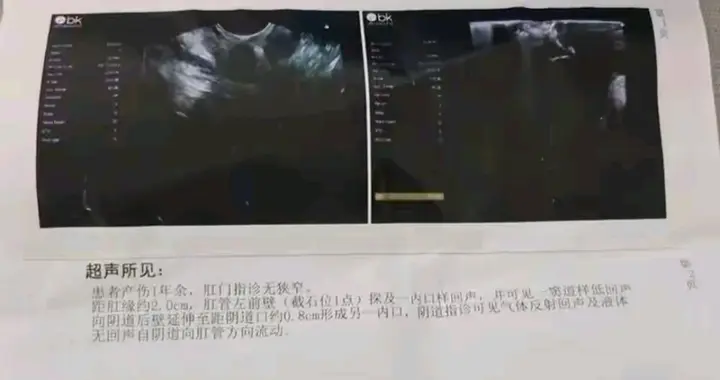 顺产竟被切漏直肠，维权两年医院只罚5万？这操作真的太扯了！