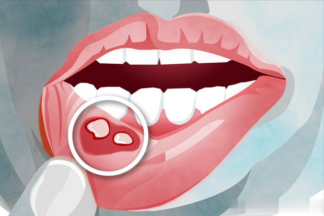 肝硬化|体内有癌，嘴巴先知？口腔出现3种迹象，可能是癌细胞“活跃”