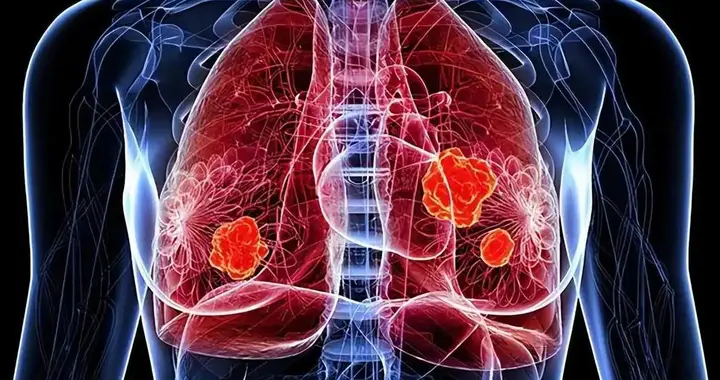 医生忠告：肺癌早期不是咳嗽，而是频繁出现这5症状，千万别忽视