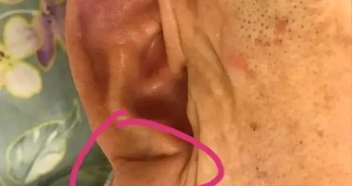 耳垂有这道斜褶？38 岁男子真实案例警示：心脏病风险或翻倍