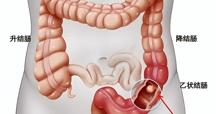 男子查出肠癌，后悔大哭：肠癌早期不是便血，而是身上4种异常