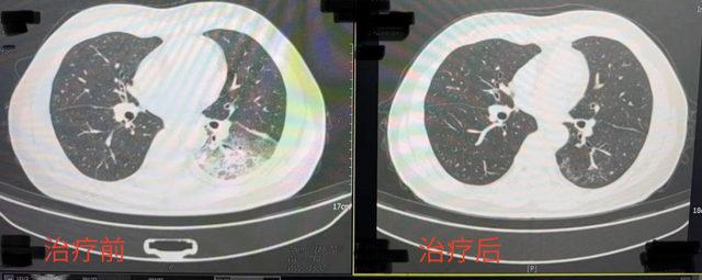 【健康】开空调3天，男子左肺“白”了近一半！吹空调缺了这一步，真的容易吹出病！