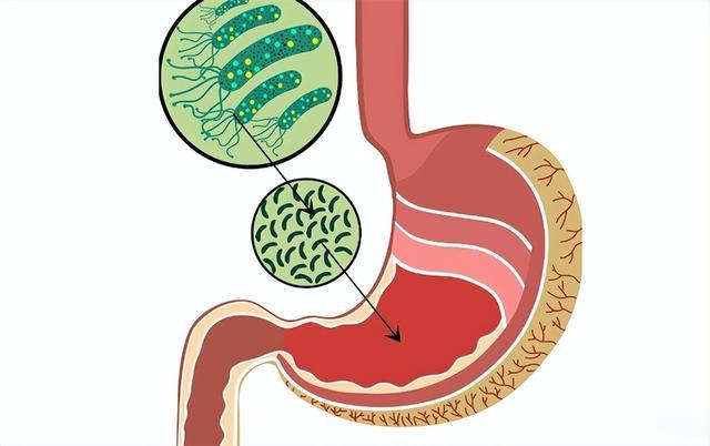 如果有这3个症状，你可能被幽门螺杆菌盯上了！千万不要忽视