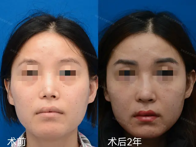 隐形唇裂鼻畸形修复术后2年