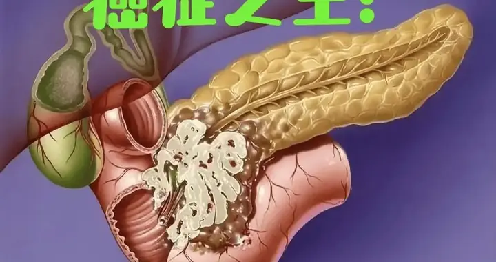 消化科医生：只要糖类抗原没这个数，胰腺癌风险就不用太焦虑？