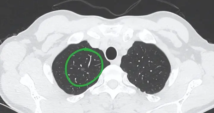 女子查CT发现肺结节，复查时结节几乎消失，只因她平时常做4件事