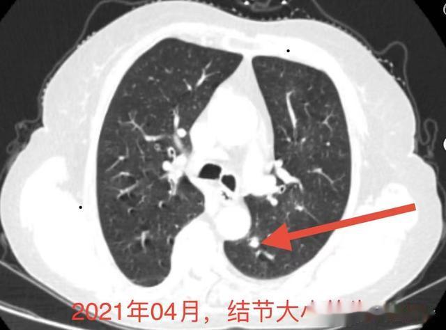 7mm的肺结节变成40mm的肺部肿块要多少年？