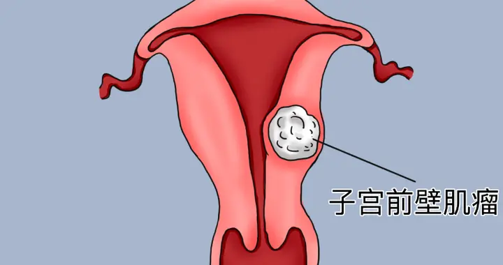 女性为什么容易长子宫肌瘤？医生提醒：建议远离6种行为，别大意