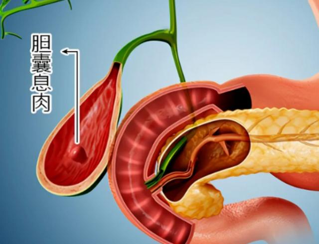 胆囊息肉，是胆里垃圾太多了，一方驱邪排毒，没必要手术伤身
