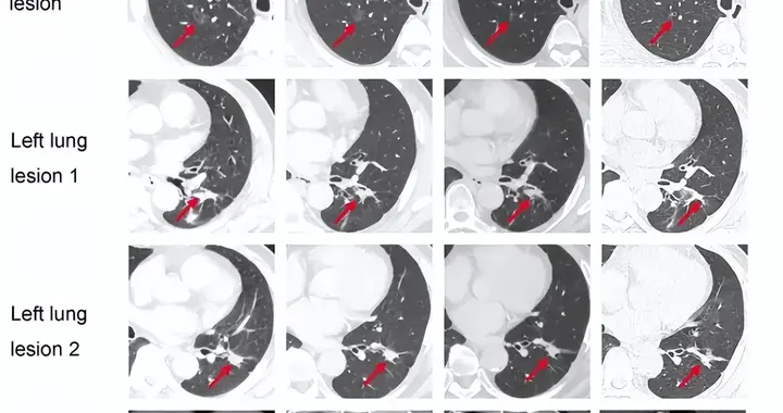 69岁肺癌病灶消失！国研疫苗XP001瞄准KRAS G12V突变肺癌及肠癌！