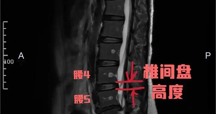 40年老中医说实话：腰突，能“治好”吗？