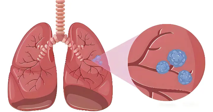 上海交大研究：肺结节防止变肺癌，教你这4招，赶紧记住了！