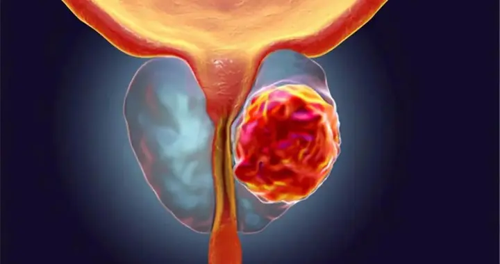 前列腺癌别等晚期才后悔，4类人群容易中招，早期治疗生存率超95%