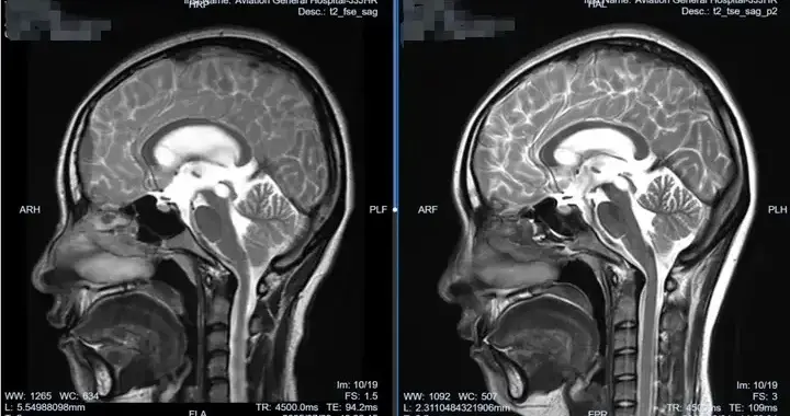 肖庆教授团队运用软性神经内镜技术成功治疗复杂脑积水