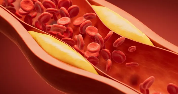 血管堵了 75% 还能恢复？不想开刀支架搭桥，还有别的办法吗？