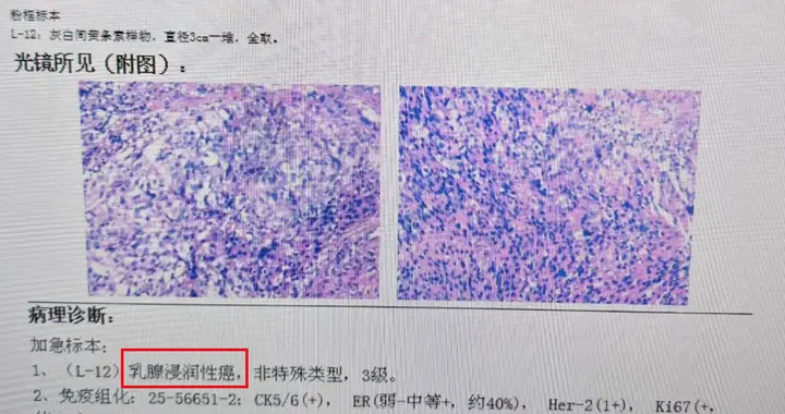 LuminalB型左乳癌，右乳良性病变——病理报告解读