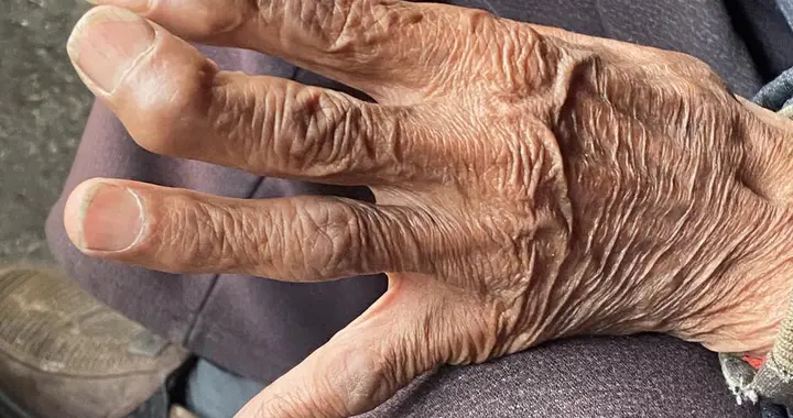 类风湿关节的隐形伤害：不止关节肿痛，还会让你慢慢失去自理能力