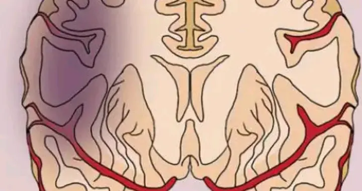 人过50岁不想得脑梗，牢记4个关键指标，稳住就能远离风险！