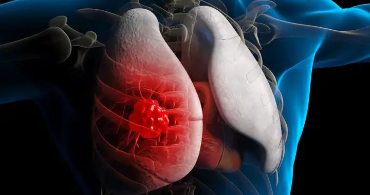 肺癌术后9个月就复发转移，有这3个特点的人更容易中招