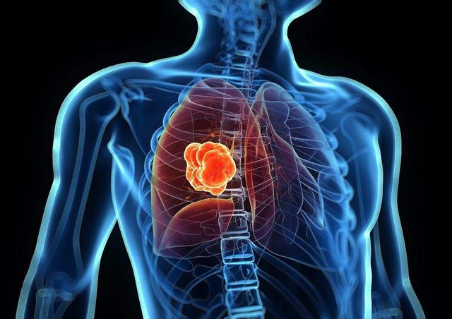 肺癌来临总是“不声不响”！提醒：身体有这3个表现，早做检查