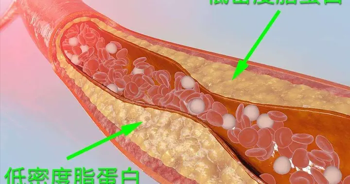 新血脂标准：低密度脂蛋白不再是唯一指标，这个比值更关键