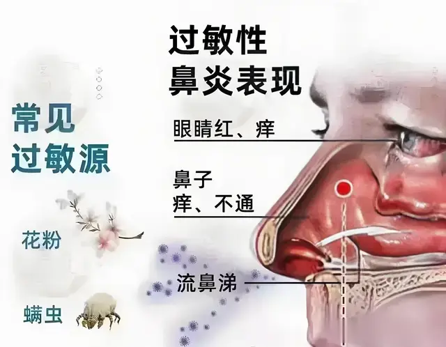 开阖枢失衡致鼻鼽：以经方调和六经，破解过敏性鼻炎千年病机