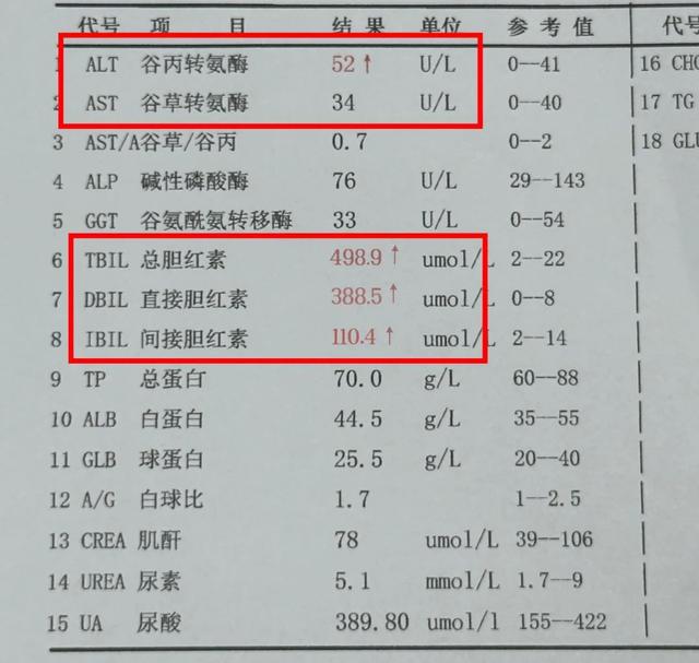 肝功能检查：别只盯着转氨酶，这1项指标升高更危险，小心肝衰竭