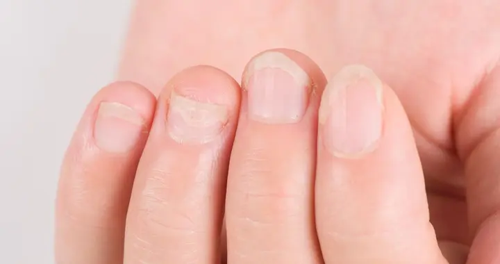 指甲变厚别不当回事！可能是灰指甲或疾病预警