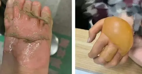 热水器爆炸女子全身95%皮肤重度烫伤：一个小疏忽，毁掉整个人生