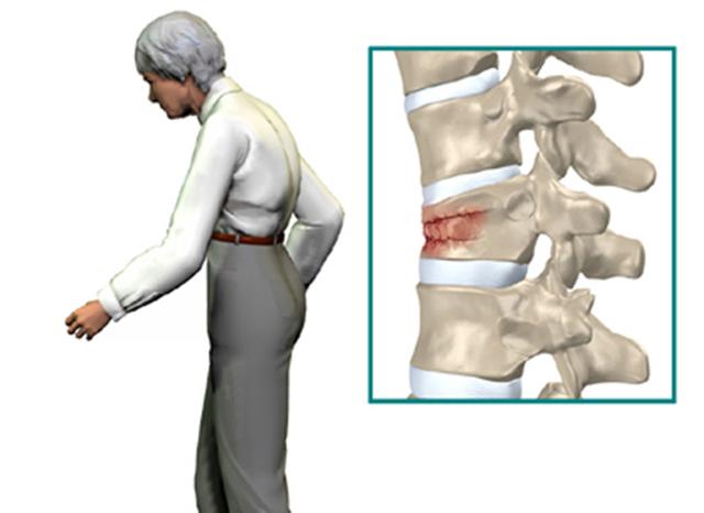 老年人驼背，身高变矮，不知不觉的压缩性骨折