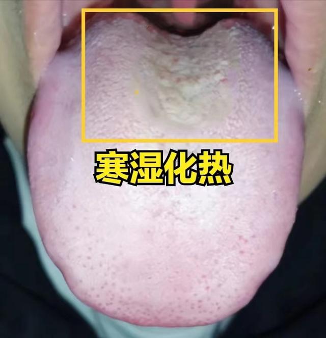看见黄腻苔就清湿热？小心阳气枯竭!中医一招温阳化湿热自消