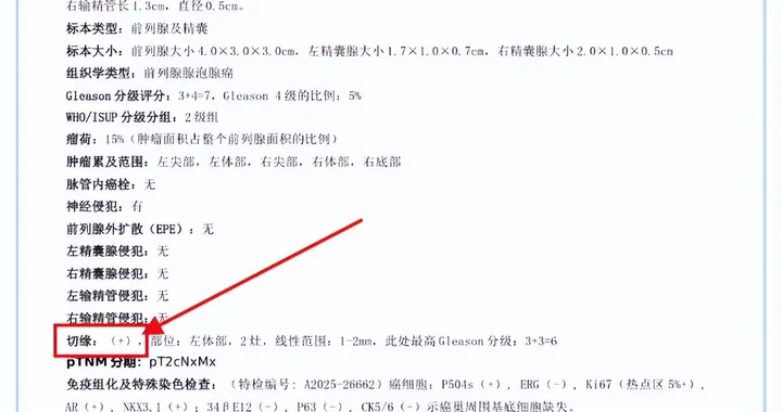 切缘阳性，肿瘤就一定会复发吗？二次手术切掉行不行？