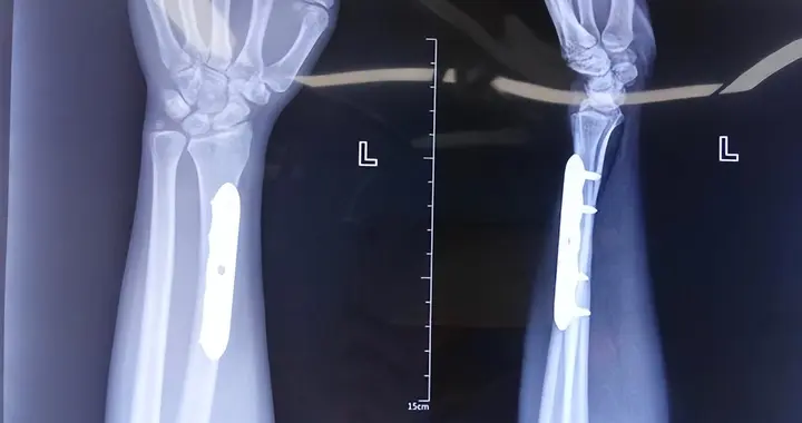 雪天一摔就骨折？补了钙还骨松？可能是忽略了这个关键因素！