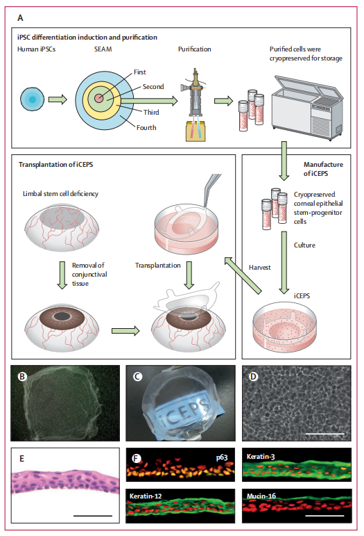 《柳叶刀》 | 干细胞疗法修复患者角膜获成功