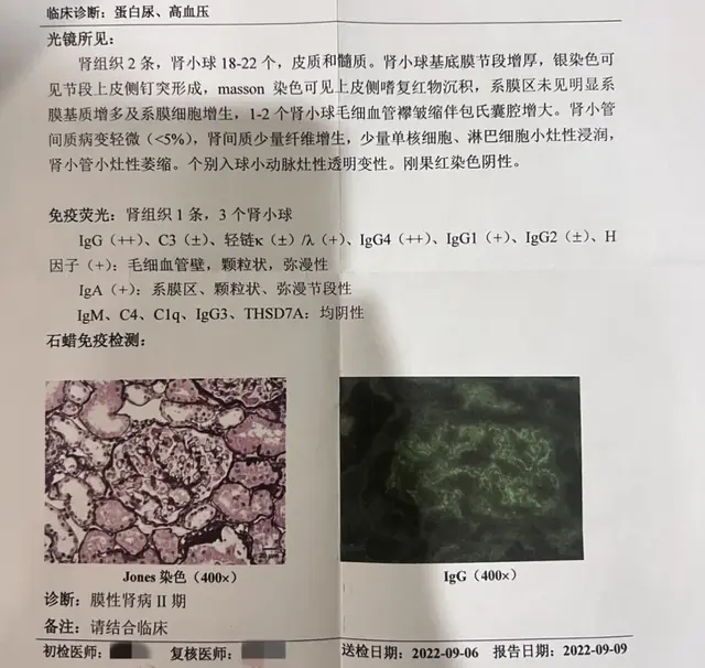 尿蛋白4g，这6年经历复发、肾病综合征用药到康复的过程！