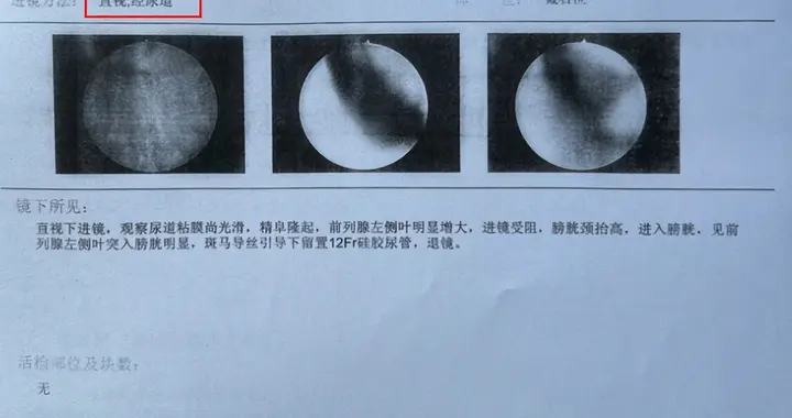 44岁前列腺癌，多处骨转移，Gleason评分5+4=9——病理报告解读