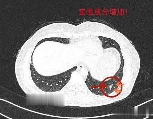 高血压|肺结节怎么切是否一定要听医生的？患方自己参与决策讨论更有益！