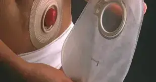 我的直肠癌经历之七。