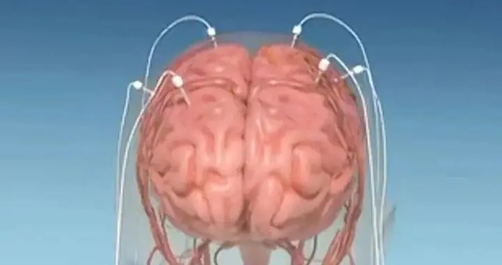 癫痫诊断黑科技：立体定向脑电图！
